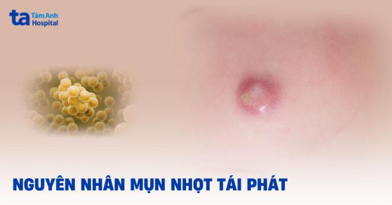 Cảnh báo không tự ý nặn mụn nhọt
